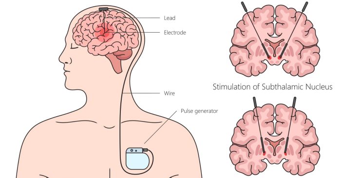 Нейростимуляція: як технології змінюють лікування хвороб мозку