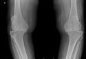 Носовой хрящ помог восстановить коленный хрящ при остеоартрите