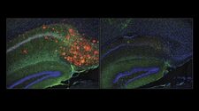 Холестерин способствовал образованию бета-амилоидных бляшек в мозге мышей